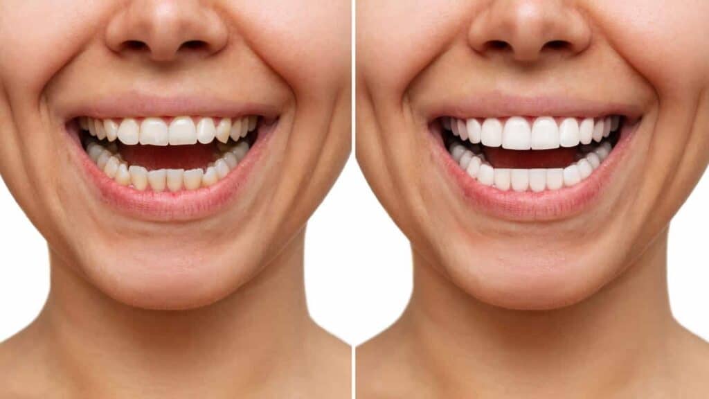 Contact Aspire White for teeth whitening services – Get in touch with Chelmsford today