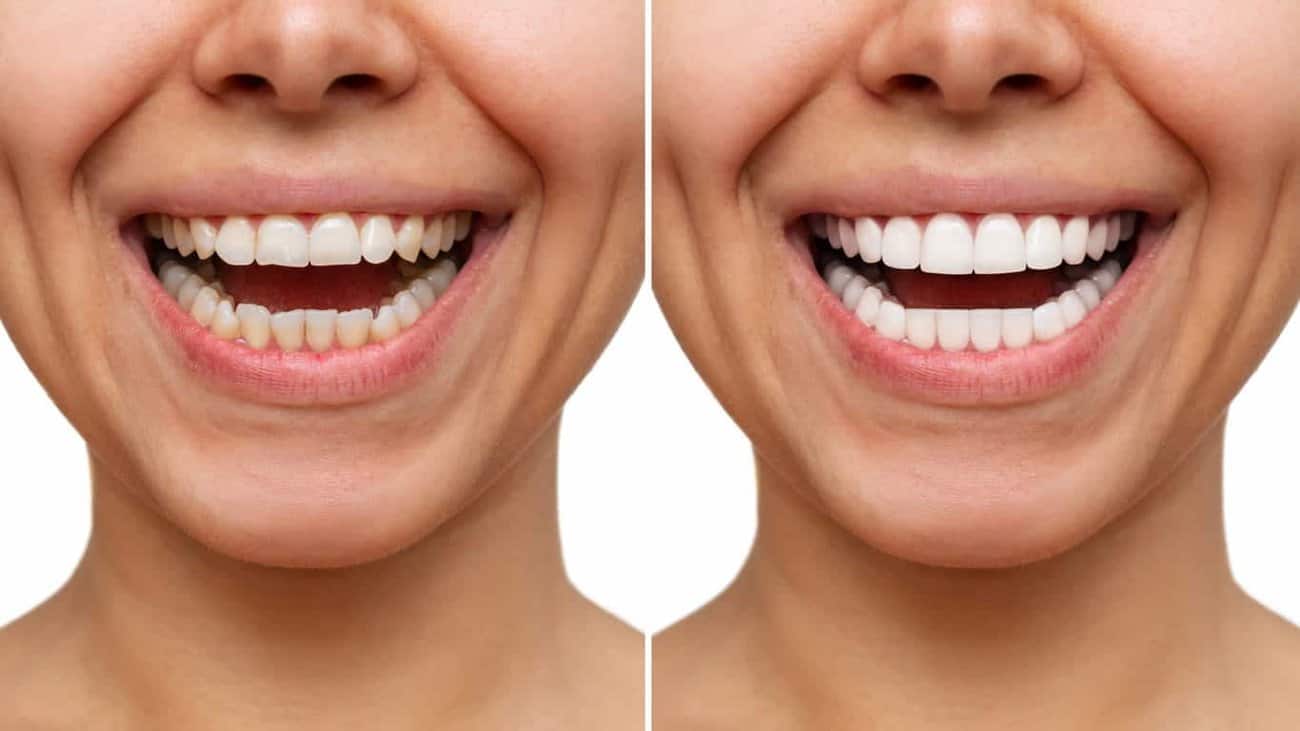 Contact Aspire White for teeth whitening services – Get in touch with Chelmsford today