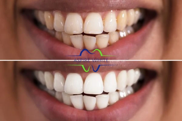 Aspire White customer before and after Chelmsford results.