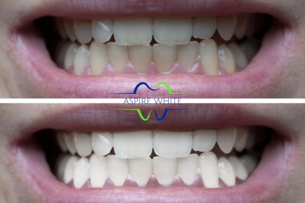 1 hour laser teeth whitening before and after results Chelmsford
