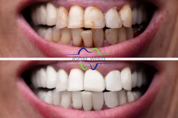 Before and after results of laser teeth whitening Chelmsford Book in online today!