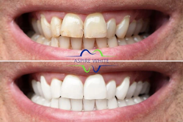 Achieve a radiant smile with professional laser teeth whitening Chelmsford